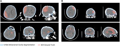 Label-efficient deep semantic segmentation of intracranial hemorrhages in CT-scans